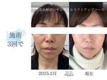 ディアスマイル(Dear.smile)/施術3回で