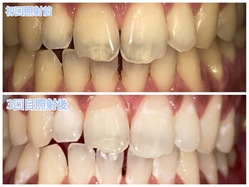 ホワイトニングラウンジ 横須賀店(ホワイトニングlounge)/【会員様before after】