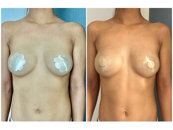 モア(moa)/症例写真