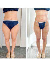 グレース(Grace luxe)/諦めていた太もももこの通り♪