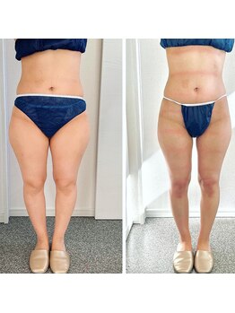 グレース(Grace luxe)/諦めていた太もももこの通り♪