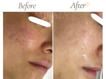 ミラリー(MIRALY)/赤みニキビくすみ4ヶ月(30代)