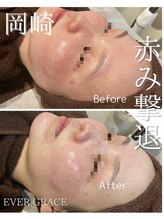 リラベル(Lira Belle)/赤みが気になる方へ