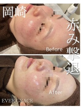 リラベル(Lira Belle)/赤みが気になる方へ