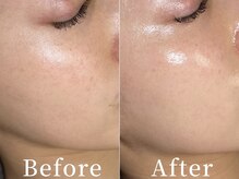 ユカリス(Yu.charis)の雰囲気（【ミコステラ】無針水光注入で渡韓せずに憧れの韓国美肌へ♪）