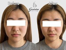 ゲントツ 新宿/小顔　小顔矯正