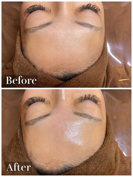 ラナ(Lana)/白玉フェイシャルワックス脱毛