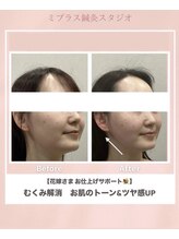 ミプラス鍼灸スタジオ/ビフォーアフター