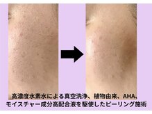 エヌフェイシャル(N.facial)/毛穴の黒ずみ除去