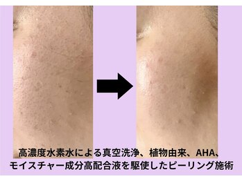 エヌフェイシャル(N.facial)/毛穴の黒ずみ除去