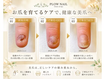 プラウネイル(Plow Nail)の写真