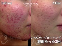 クリーンアンドビューティ 札幌(Clean&Beauty)/跡や赤みにも根本からアプローチ