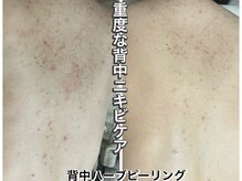 ハービー(Herbee)/背中のニキビケア