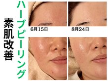 エリン(ERIN)/毛穴徹底洗浄×ハーブピーリング