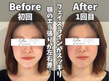 鍼灸整体院ユー(鍼灸整体院You...)/美容鍼×小顔矯正　施術後の変化