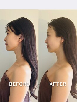 スワフルール(soi Fleur)/女優kogao矯正