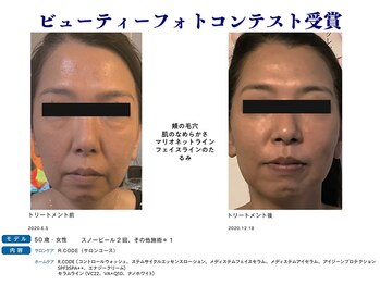 アドミーロ/ホワイトスノー2回+ホームケア