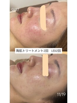 サロンモア(salon More)/陶肌トリートメント+LED