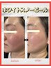 【再来1カ月以内】ホワイトスノーピール美白＋小顔調整フェイシャル70分