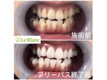 ルブラン 奈良店(Le Blanc)/歯が白くなると。。。