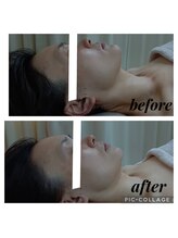 クリオネ(Clione)/ＢＢＬ光フェイシャル