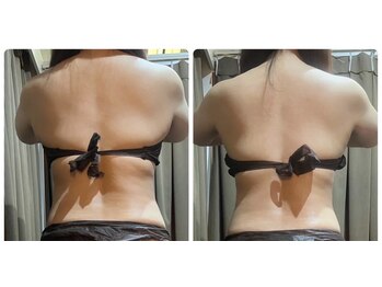 さとう美容整体 町田店/ハイパーナイフEX1回