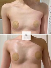 エムクリニカルラボ 藤沢(M clinical lab)/脂肪増加剤導入バストアップ