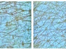 アネモネ 心斎橋院/生ハーブピーリング1回の変化