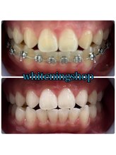 ホワイトニングショップ 日進店/Before After日進ホワイトニング