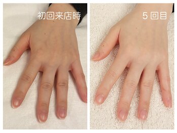 キレイテ 福岡天神店/40代/5回目【大名ハンドケア】