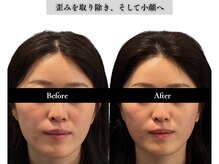 アロエベル(aloe Belle)/Before After（1回施術）