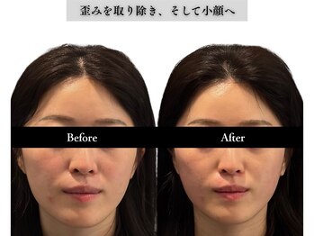 アロエベル(aloe Belle)/Before After（1回施術）