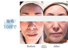 ディアスマイル(Dear.smile)/施術10回で