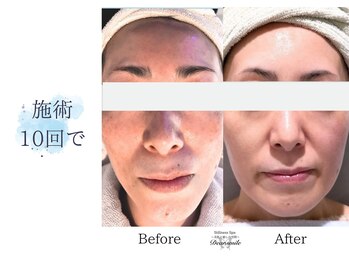 ディアスマイル(Dear.smile)/施術10回で