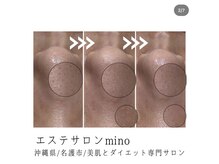 ミノ 美里大通り店(mino)/小鼻の黒ずみも改善☆