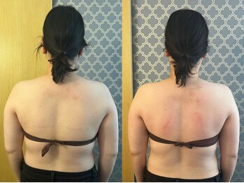 マイティー整骨院 ココア(CoCoa)/肩甲骨洗浄