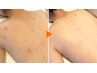 脱毛×ピーリングで贅沢ケア☆背中脱毛＆ピーリングでツルんと美背中に◎
