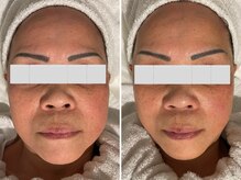 プライベートエステティックサロン クール(Coeur)/【トータルエイジングコース】