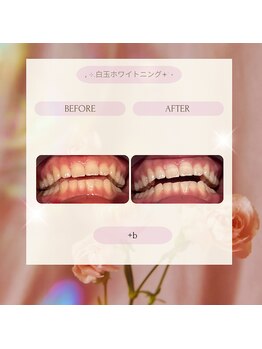プラスビー 2号店(+b)/ホワイトニングビフォーアフター