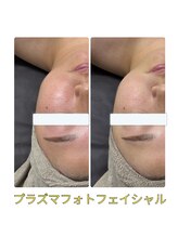 アーク(ARC)/プラズマフェイシャル