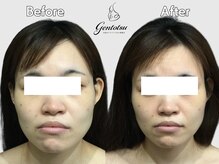 ゲントツ 新宿/小顔　小顔矯正