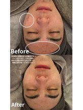 ニコ(nico)/ニキビ・肌荒れもこんなに変わる