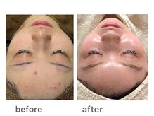 リノア(Lino'aka)/セルマン サロンケア1回目