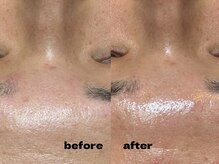 アンノウン 梅田店(Unknown.)/メンズフェイシャルワックス