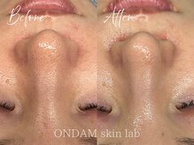 オンダム 南青山 表参道(ONDAM)/【毛穴の黒ずみ・開き】