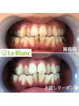 ルブラン 奈良店(Le Blanc)/ヤニ、茶渋等落とします！！