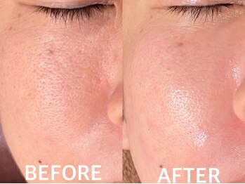 ハーブピーリング 恵比寿/施術回数3回 ハーブピーリング