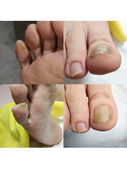 【肥厚・変形爪】ネイル/フット