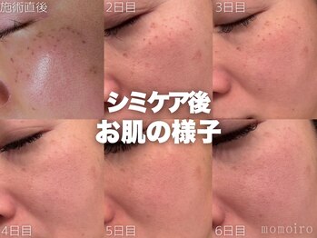 モモイロ(momoiro)/シミケア後の様子