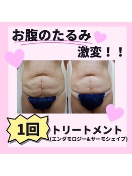 エルクレスト 新宿店/１回での効果